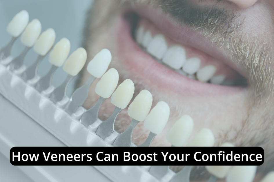 A close up of teeth, showcasing how dental veneers can boost confidence with a flawless smile.